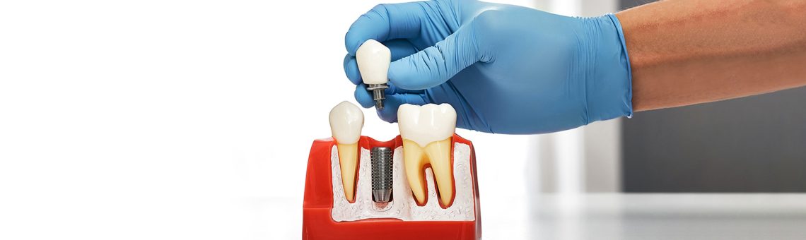Recovery Timeline for Dental Implants: From Surgery to Smile