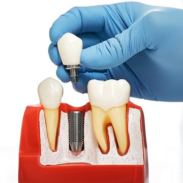 Recovery Timeline for Dental Implants: From Surgery to Smile