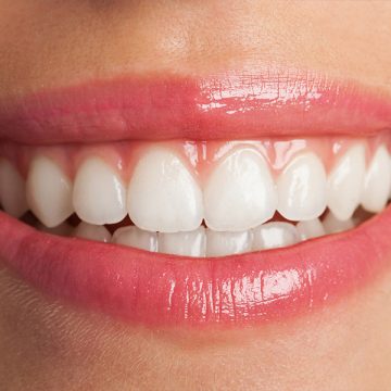 How Long Does Teeth Whitening Last? Everything You Should Know